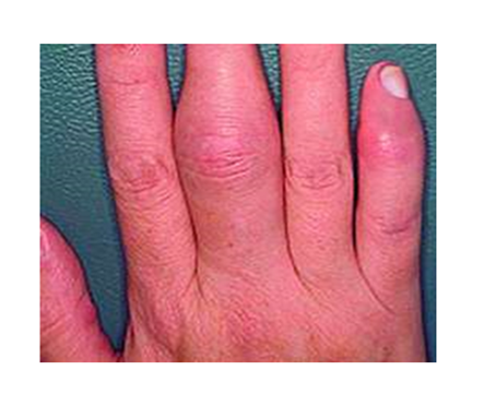 ízületi betegségek az ujjakon