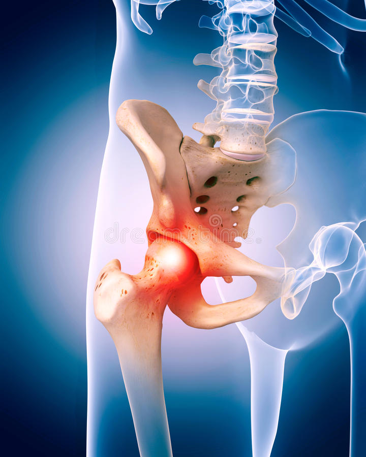 Mi okozza a csípő- és keresztcsonti fájdalmat?