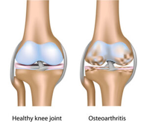 Gyakorlatok osteoarthritis a térd, a komplex
