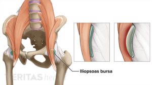Ízületi fájdalom és ágyék jobb oldalon, A térd artrózisának radiológiai stádiumai