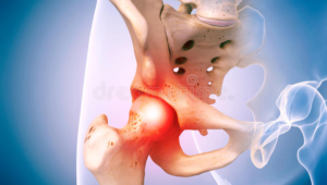 csípő- és medencefájdalom az osteochondrosis kezelése az akut stádiumban