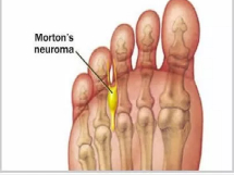 Morton neuroma