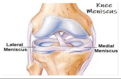 meniscus szakadás tünetei)