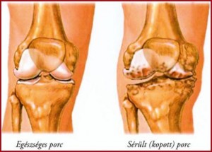 a térdízület oldalsó ízületei fájnak