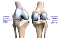 hátsó keresztszalag szakadás tünetei a lábujjízületi tünetek