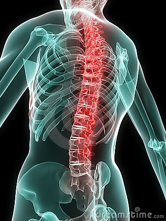 Spondylitis Ankylopoetica 1