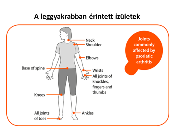 A betegség álltal leggyakrabban érintett izületek