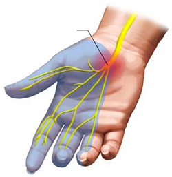 carpalis alagút szindróma