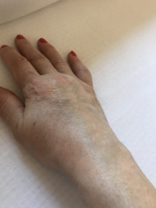 bursitis