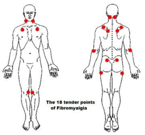 fibromyalgia