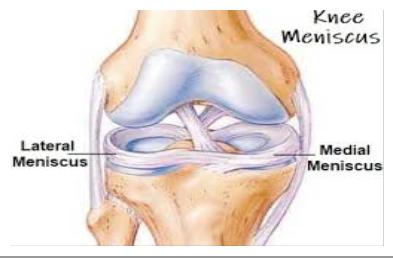 a térd mediális meniszkuszának károsodásának tünetei