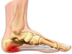 Sarok boka fájdalom, A sarok, a boka és a lábfej is fájhat Achilles-ín gyulladás miatt