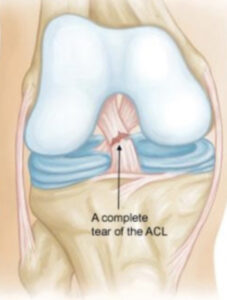 ACL sérulés rehabilitációja