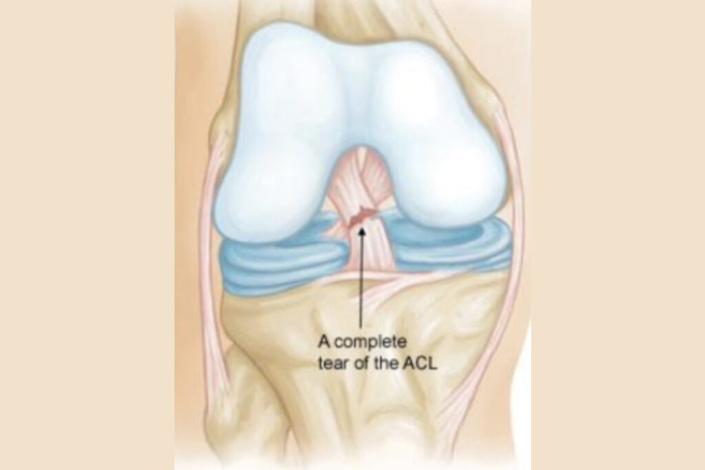 Elülső keresztszalag (ACL) sérülés tünetei, rehabilitáció, fontos tanácsok