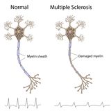 sclerosis multipliex
