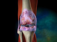 gerinc és ízületek kobaltcsíra betegségei arthrosis osteophytes kezelés