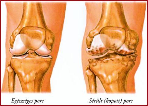 Így előzhetjük meg a fájdalmas ízületi kopást