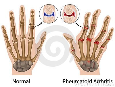 a kéz ízületeinek osteoarthritis kezelés