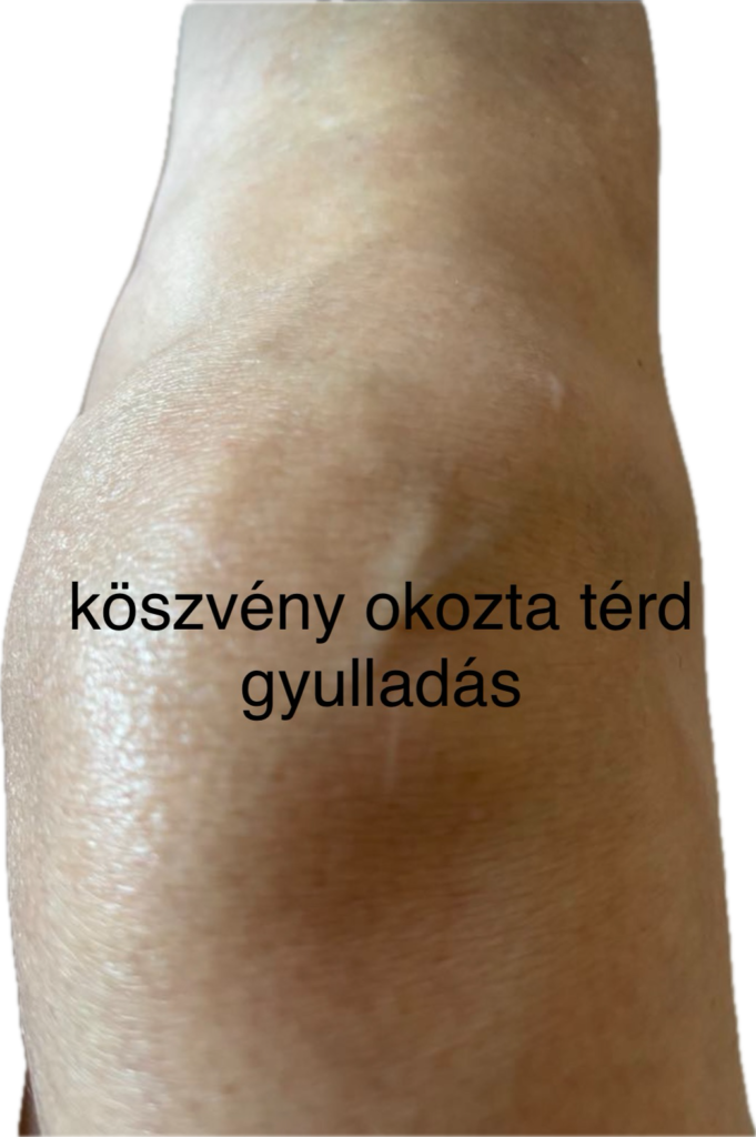 Köszvény és álköszvény tünetei, kezelése Köszvény és álköszvény tünetei, kezelése