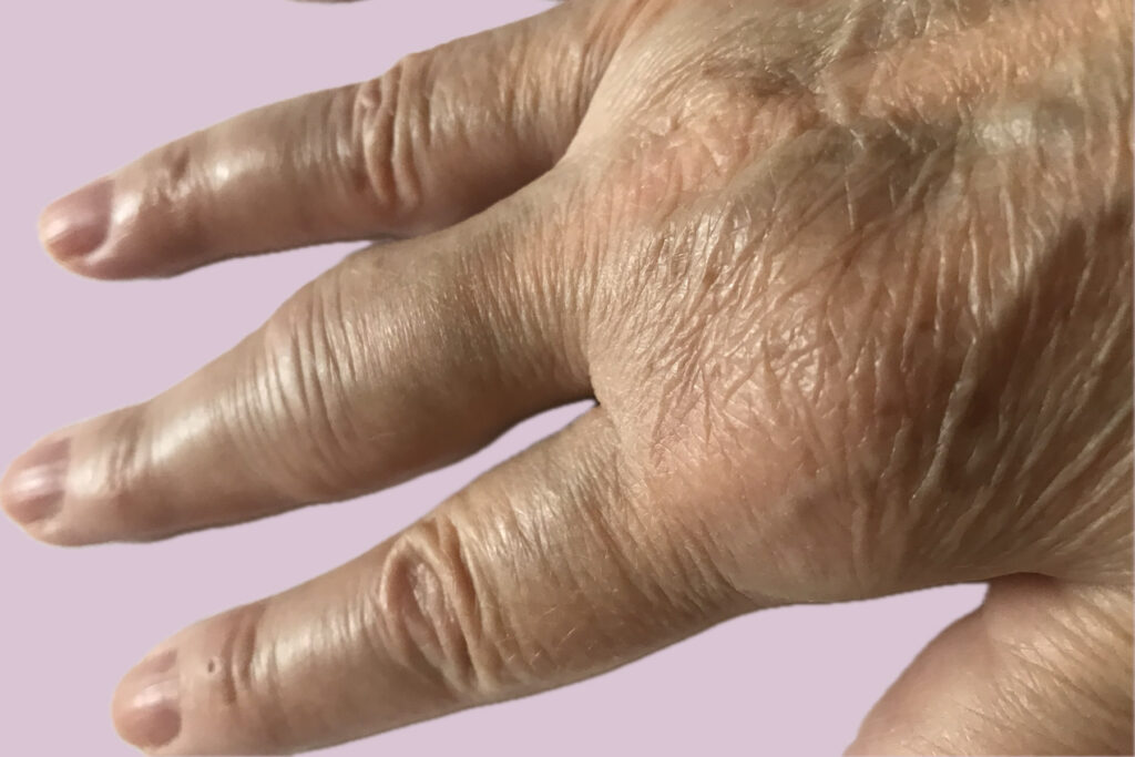 Rheumatoid arthritis (RA) és rehabilitációja