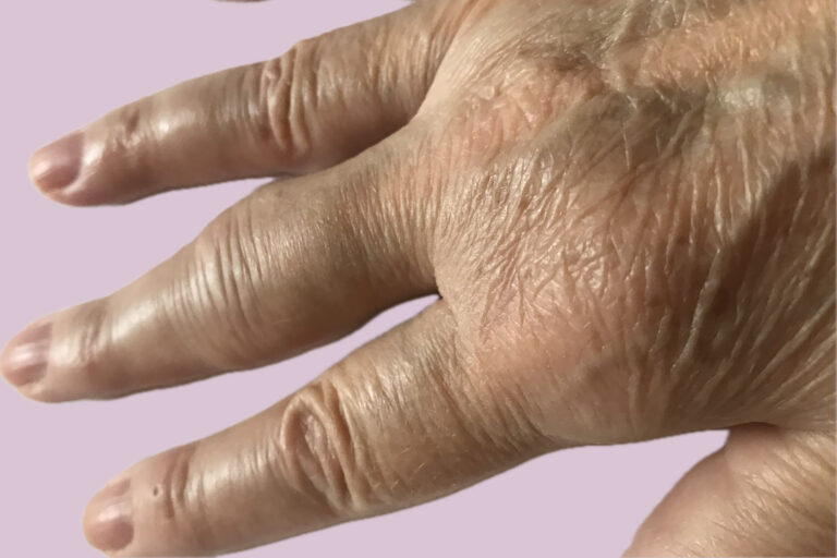 Rheumatoid arthritis (RA) és rehabilitációja